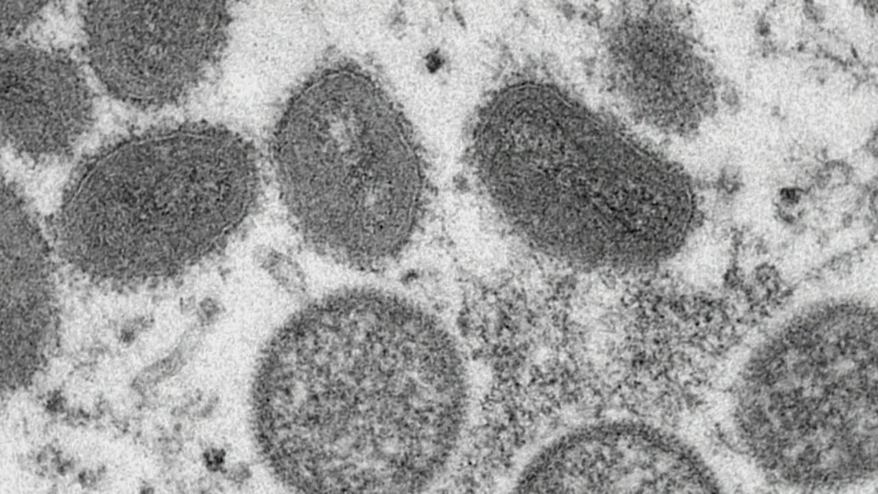 1st case of monkeypox detected in Minnesota