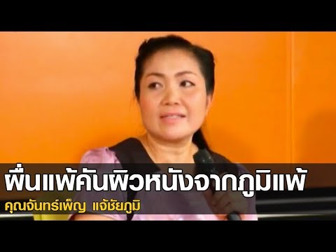 โลชั่นจีนโรคสะเก็ดเงินบริสุทธิ์ ทารกกลาก 3 เดือน