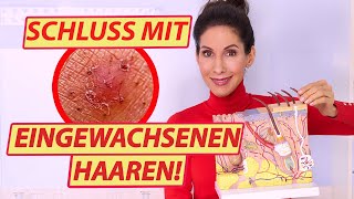 So wirst Du endlich eingewachsene Haare los - Profi Tipps von der Hautärztin