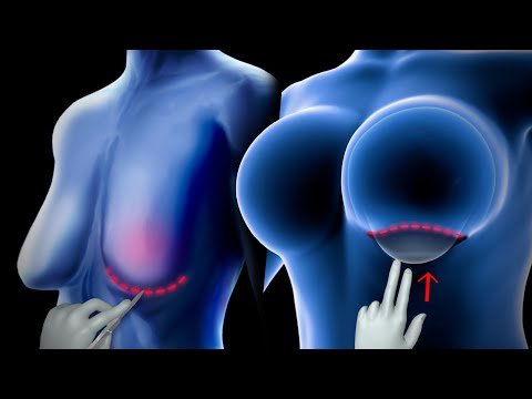 Latest Advancements in Breast Augmentation Surgery