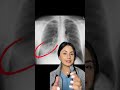 Chest X Rays 🩻