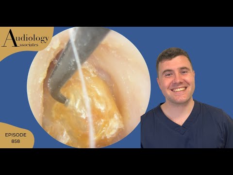 3 DIFFERENT KERATIN REMOVALS FROM EARS - EP858