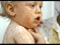THE MEASLES informational video - YouTube