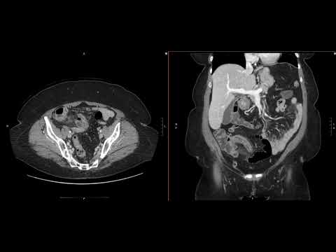 Abdominal Imaging Call Prep Cases: Perforated Appendicitis (CT) Search Pattern