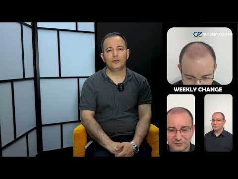 Hair Transplant in Turkey: Real Patient’s 3-Month Transformation at Clinic Expert