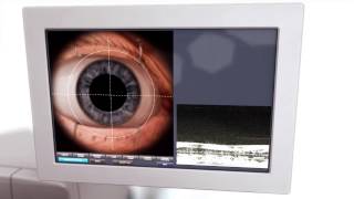 preview picture of video 'Animation Bladeless Laser Cataract Surgery with Alcon LenSx Laser'