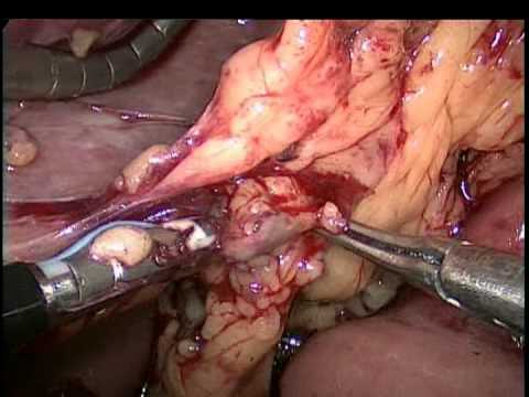 Resección gástrica limitada laparoscópica