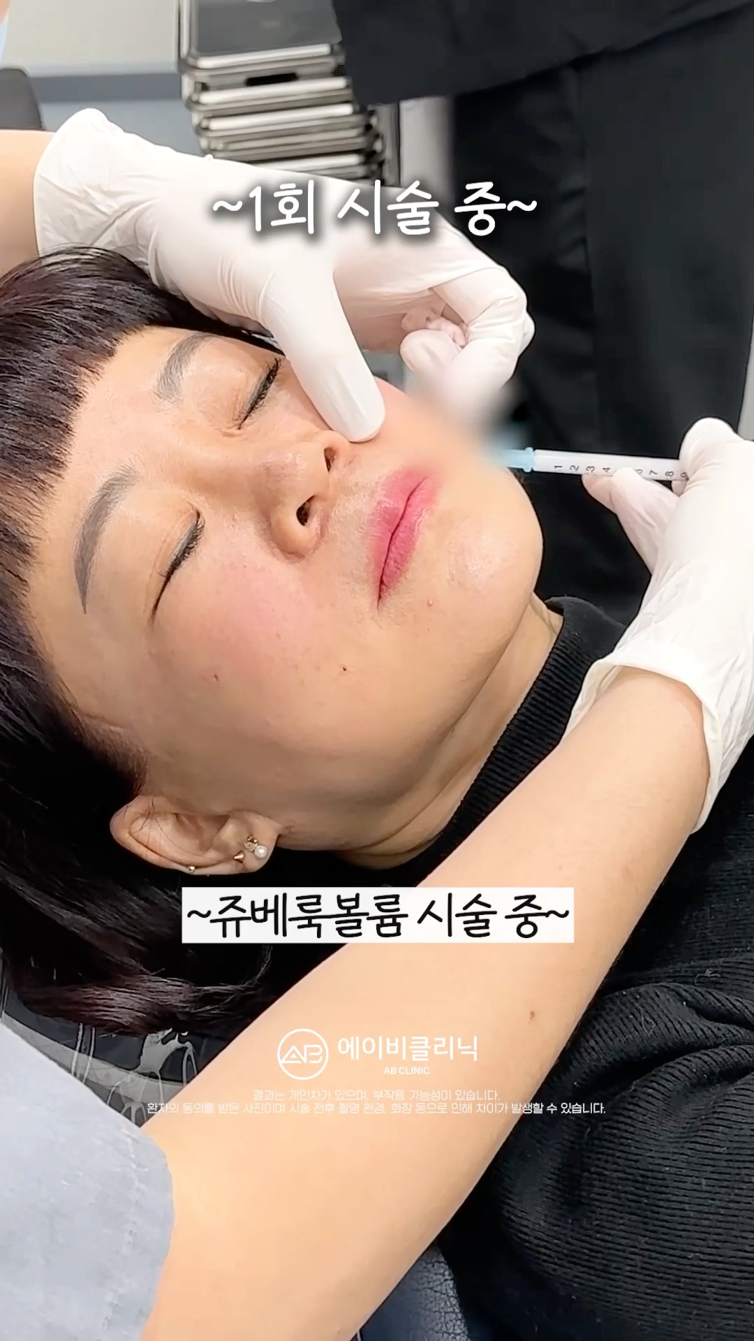 반드시 효과보는 팔자주름 지우개