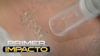 Los tatuajes ya no son para siempre