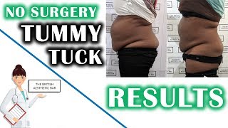 Belly Fat Reduction Without Surgery | Non Surgical Tummy Tuck in London | Full Procedure