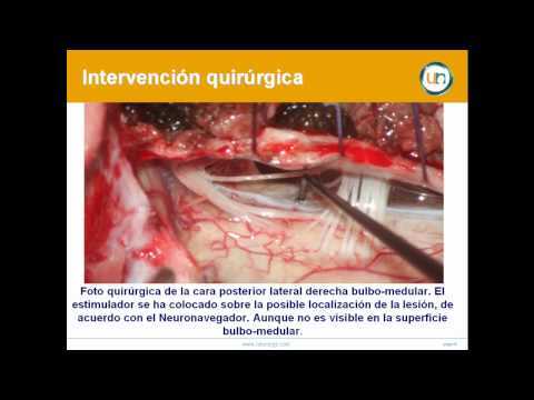 Cavernoma en la Unión Bulbo-Medular