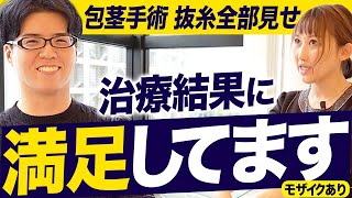 【手術見せ】包茎治療後2週間の抜糸と、患者のリアルな本音とは