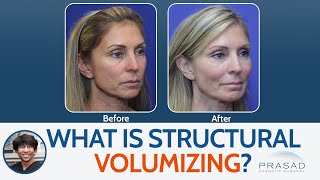 Fillers Without Migration