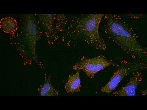 Immunothearpy combo treating advanced cervical cancer | OSUCCC – James