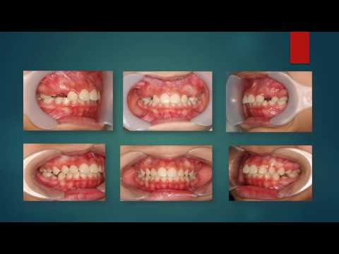 Niềng răng, nắn chỉnh răng -  invisalign-  Braces - before and after.