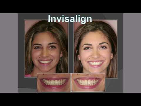 download lagu mp3 mp4 Invisalign Orlando Florida, download lagu Invisalign Orlando Florida gratis, unduh video klip Invisalign Orlando Florida