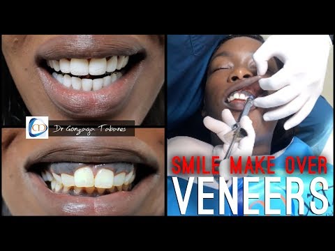 My Colombian SMILE MAKEOVER | Non Prep Veneers w/ Clinicas Matizz