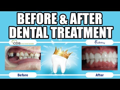 Before and After Dental Implants and Dental Veneers in Cancun, Mexico