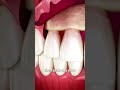 The Surgery To Reveal More Teeth 😨 - Zack D. Films The Surgery To Reveal More Teeth 😨