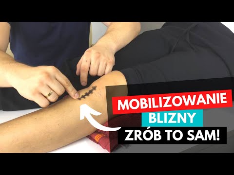 Forum deformacja stóp Odkształcenie leczenia palce