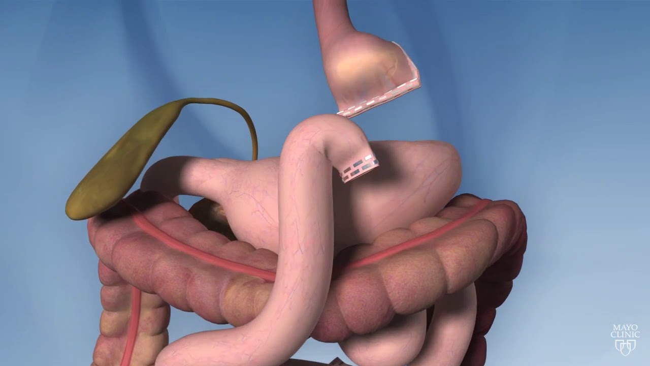 Roux-en-Y Gastric Bypass