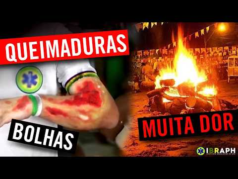 QUEIMADURAS: Tipos, CONDUTAS e Quando Ligar para O SAMU? | Primeiros Socorros