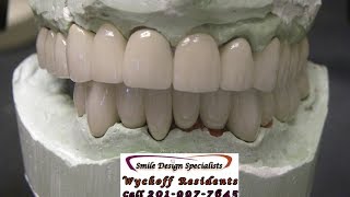 preview picture of video 'Porcelain crown information Wyckoff nj call 201-991-1228 Smile Design Specialist'
