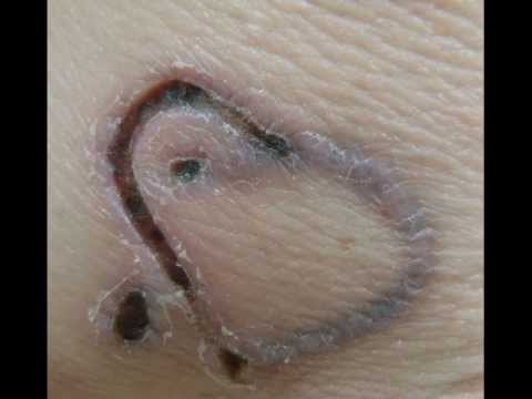 June 2010, Tattoo Removal Cream Injections Is A Relatively New Method ...