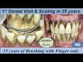 Massive Firm & Hard Black Calculus Removal by Ultrasonic Scaling I 1st Dental Cleaning in 35 years