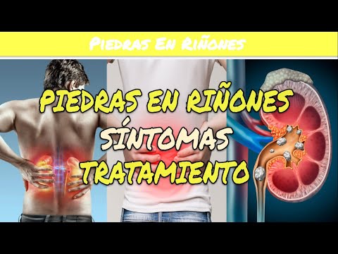 ⚕️🩺 Lower back pain on the right side - Kidney stones