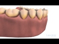 Dental Floss Lapointe Dental Centres