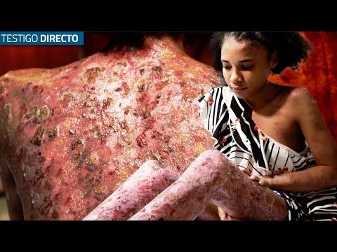 Así Se Vive Con Dolor Por Todo El Cuerpo Por Esta Extraña Enfermedad - Testigo Directo