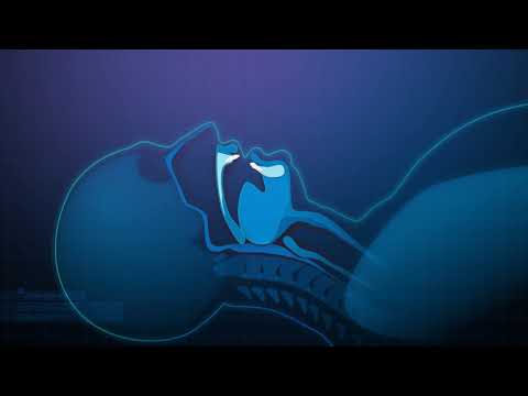 So wirkt sich die Schnarchschiene Narval CC auf Schlafapnoe aus [BF]