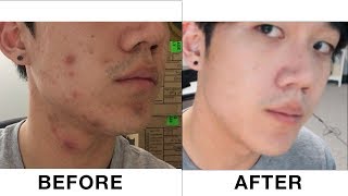 BANISH Acne Scars, Does It Really Work? | Plus my NEW apartment!
