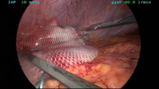 Laparoscopic Ventral Hernia Repair - (Hybrid) IPOM with defect closure Laparoscopic Ventral Hernia Repair - (Hybrid) IPOM with defect closure