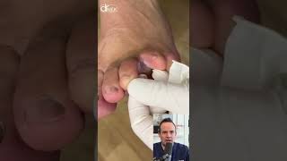 DOCTOR REACTS: FUNGUS🍄 INFECTION BETWEEN TOES!😱 #shorts #reaction