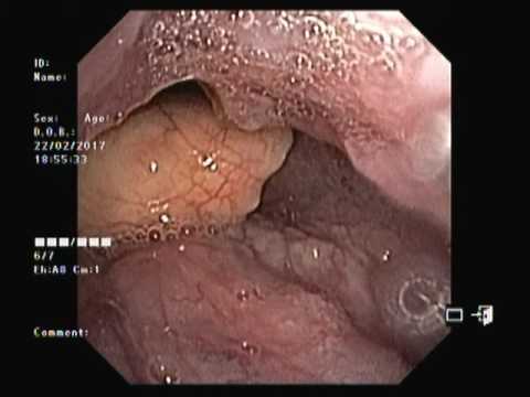 Hpv warts vs herpes