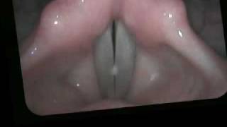 Vocal nodules