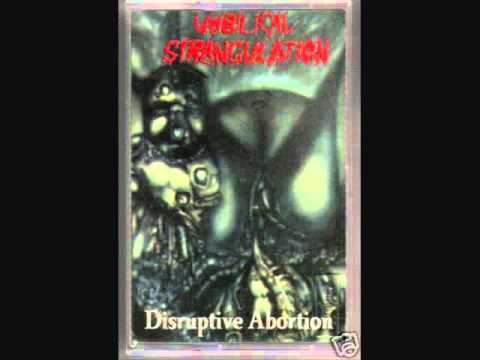 Umbilical Strangulation - Fetal Death - Disruptive Abortion 1996