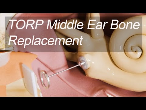 Mittelohr-Knochenersatz - Total Ossicular Replacement Prothese (TORP) bei Hörverlust