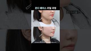 온다리프팅 시술 직후 효과