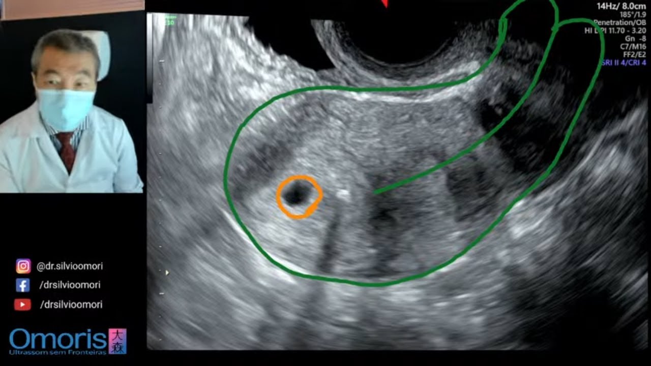 GRAVIDEZ COM DIU! Mesmo com esse dispositivo contraceptivo, houve fecundação e gestação.