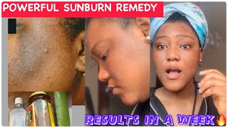 HOW TO CLEAR SUNBURN NATURALLY || REMOVE HYPERPIGMENTATION/ DARK SPOTS/ SCARS FAST