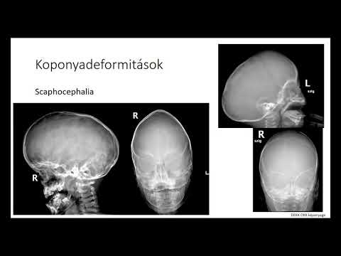 Mi a rosszindulatú magas vérnyomás és hogyan. Amikor tünet a magas vérnyomás: a Conn-szindrómáról