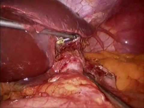 EndoLift for Liver Retraction During Gastric Bypass