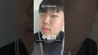 교정중인데 성형수술 해도되는지 교정전문의가 정확하게 알려드립니다!!!