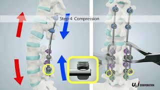 Lumbar   Level Extension Device   Perfix LED   Surgical Tech
