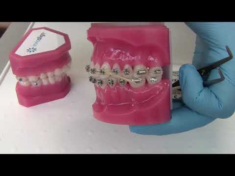 How to wear Elastics for Orthodontic Treatments (Braces and Aligners)