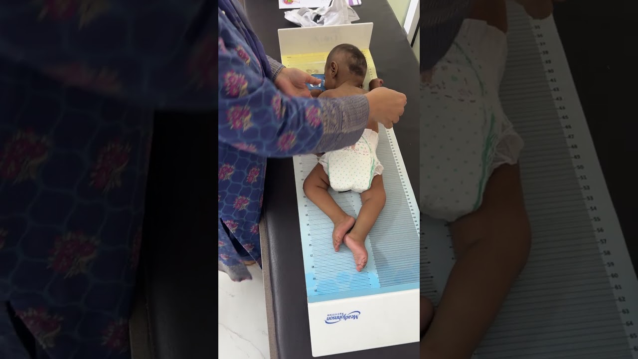 Floppy weak  infant SMA type 1 بچوں کی موروثی پٹھوں کی کمزوری کی بیماری