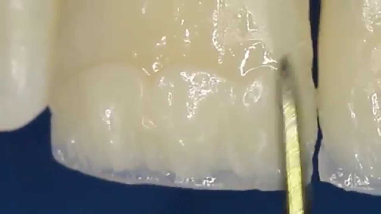 Incisivos Centrais. Restaurações em Resinas Compostas